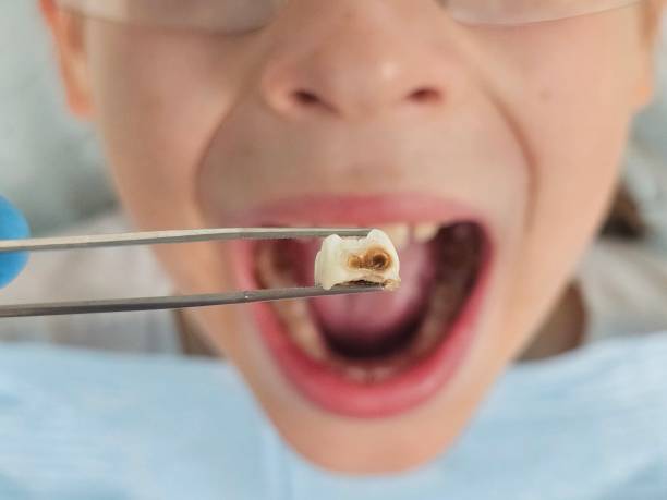 Best Emergency Treatment for Toothache in Pacific Grove, CA